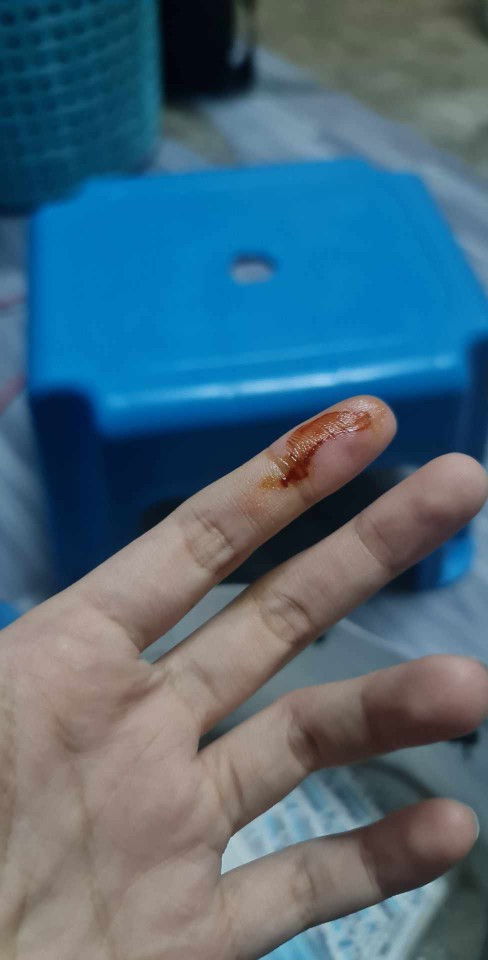 โดนแมวข่วนนิ้ว