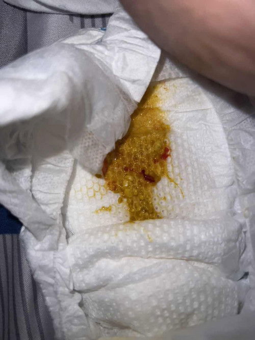 Berak berlendir merah pada bayi perempuan