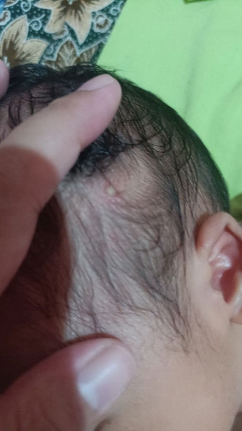 Bentol kecil seperti isi nanah