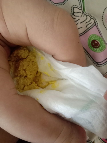 Nagtatae po ba si baby