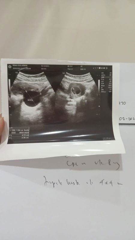 Usia 8w tapi ada kista ada yang pernah mengalami ngga ?