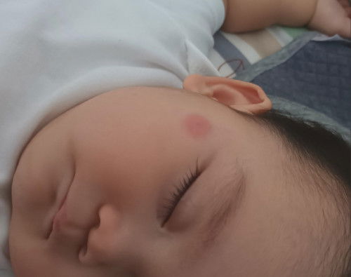 Gigitan serangga sampe merah gini diobatin pakai apa ya bun?