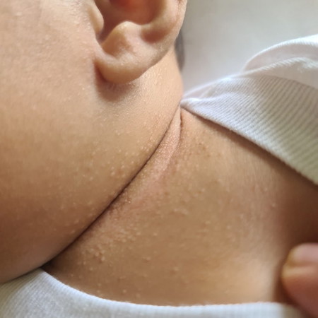 help po sa Baby Rash