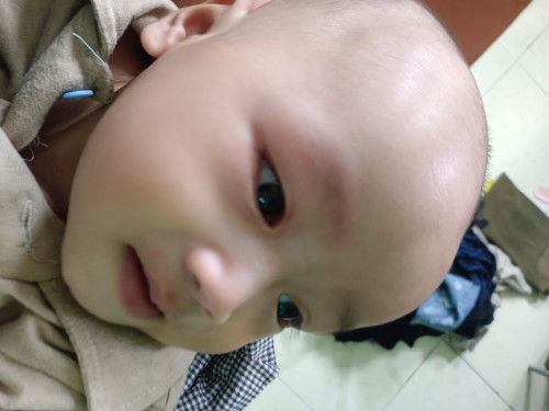 Mata baby terkena minyak telon