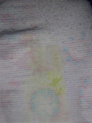 Yellowish or greenish discharge??