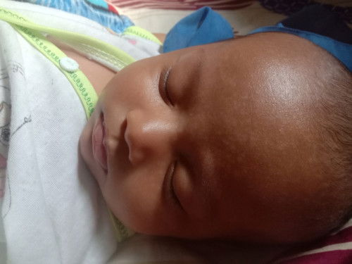 Kulit bayi seperti panu