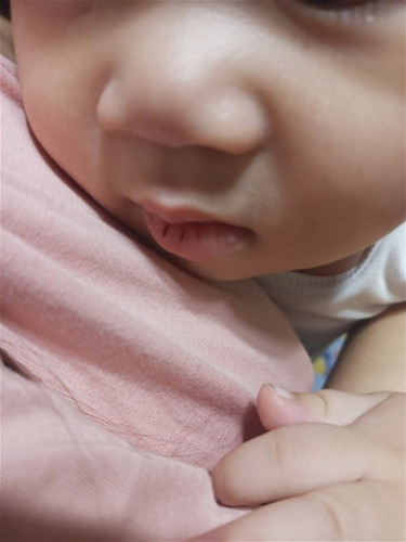Chapped Lips @ 8months.