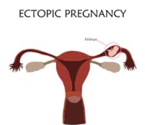 PANTANG SELEPAS TEBUK UNTUK ECTOPIC PREGNANCY
