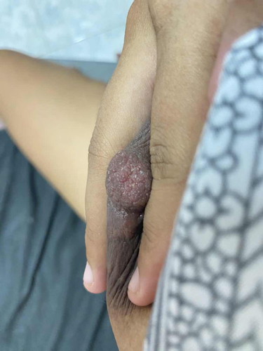 หัวนมเป็นสะเก็ด แม่ๆท่านไหนเป็นบ้างคะ