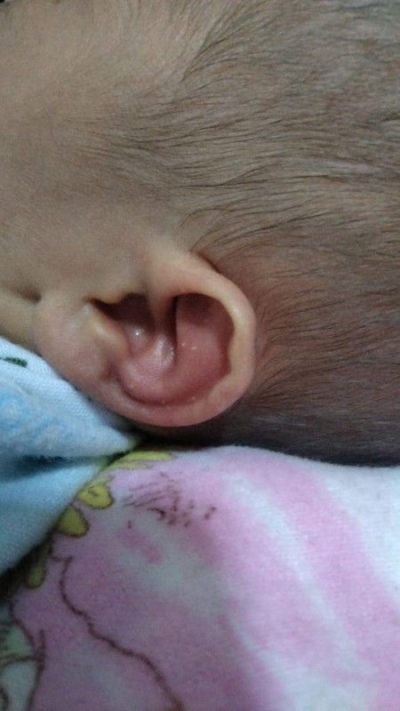 Bintik merah d telinga bayi usia 7 hari
Mohon infonya dong cara obatinya,