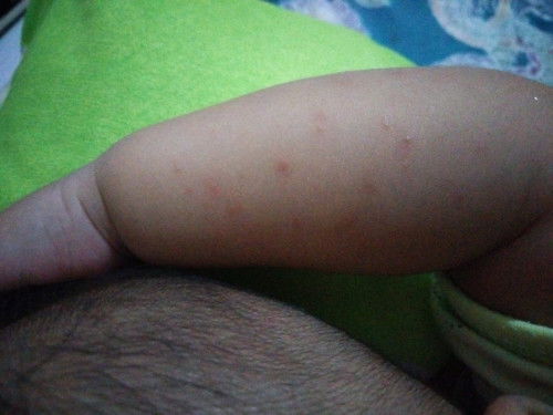 Apa ini biang keringat?