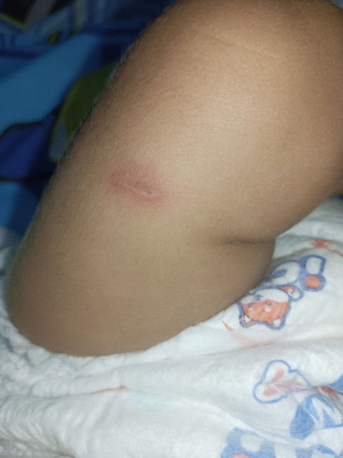 ไม่รู้ว่าแมลงอะไรกัด!!