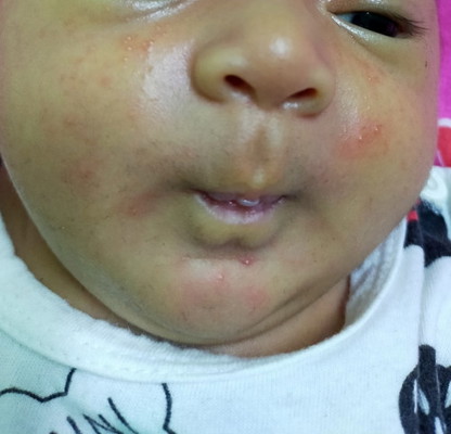 Ruam muka baby