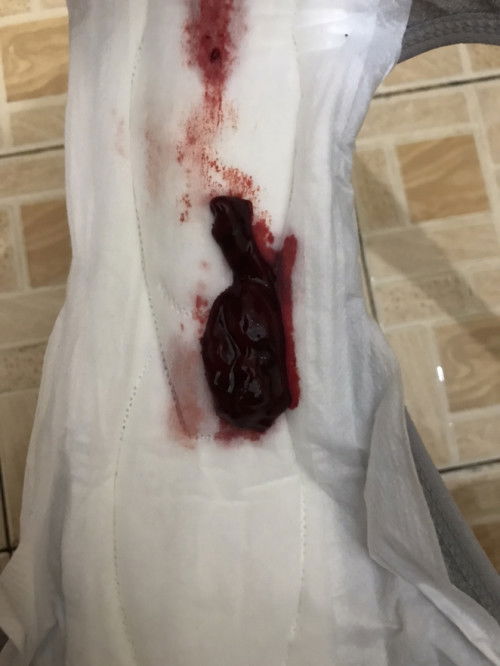 keluar gumpalan darah