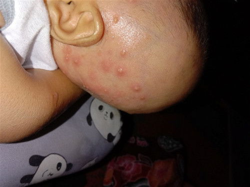 Bayi 2 bulan bintik2 dikepala