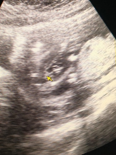 ตั้งครรภ์18w ท้องลูกคนแรก