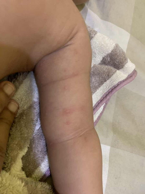 Bayi 5bulan kena gatal gatal