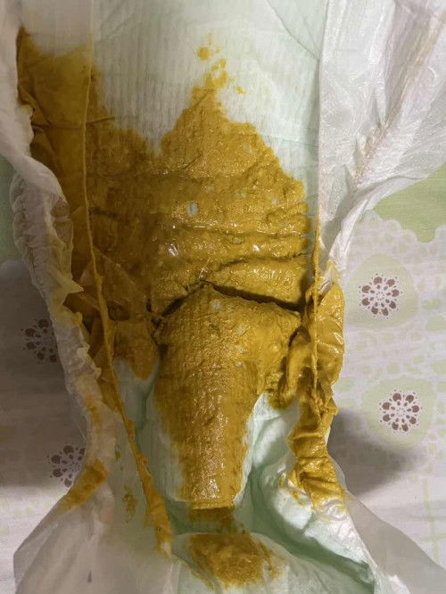 ลูกอึแบบนี้ผิดปกติมั้ยคะ