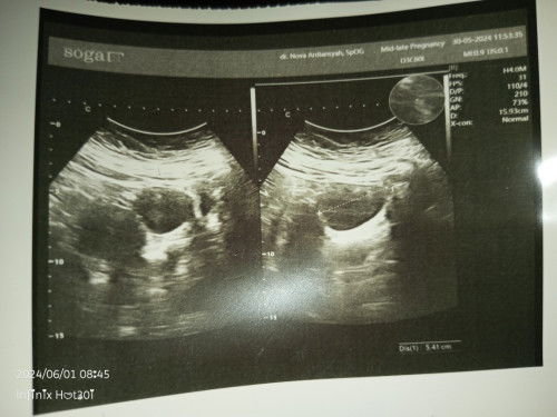 ada yg sama ga sih ?
tespek udh positif,pas usg 4D blm ada kantung janin,mlah yg terliht ada kista🥹