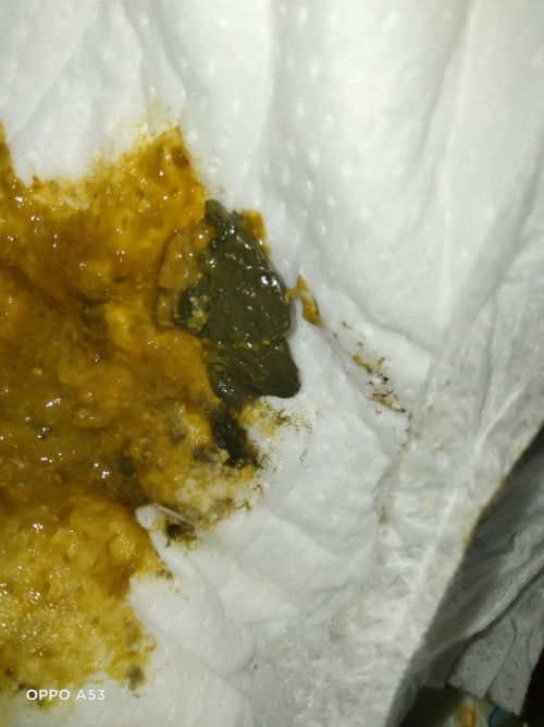 อึแบบนี้ควรเปลี่ยนนมมั้ยค่ะ