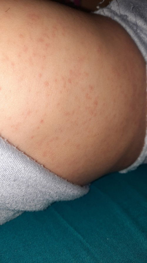 Badan bintik bintik merah