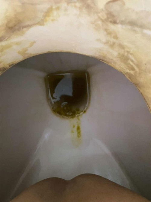 สอบถามค่ะแม่ๆ แบบนี้น้องติดเชื้อรึเปล่าคะ น้องท้องเสียมา4-5วันแล้วถ่ายเหลวสีดำ ไปรพมาให้เกลือแร่กับยาเจ็บท้องมาให้ก็ไม่หาย