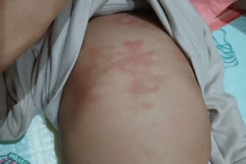 Cara mengatasi masalah kulit bayi