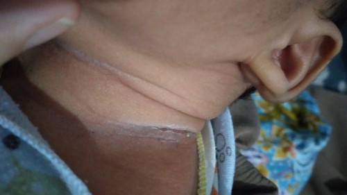 Dilipetan leher dan selangkangan bayi newborn seperti ini knp ya?