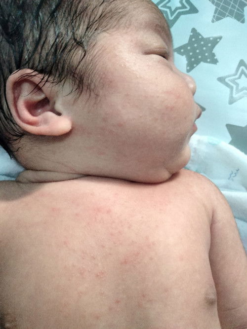 ผื่นแบบนี้อันตรายมั้ยคะควรพาน้องไปหาหมอมั้ยคะแม่ๆ