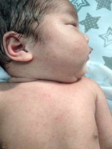 ผื่นแบบนี้อันตรายมั้ยคะควรพาน้องไปหาหมอมั้ยคะแม่ๆ