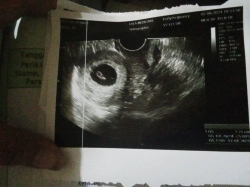 3hari seblm'y pernah ngflek & pas tdi ngecek lagi & USG ternyata detak jantung nya sudah tidak saran