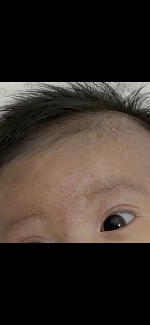 Ano po treatment sa Baby acne