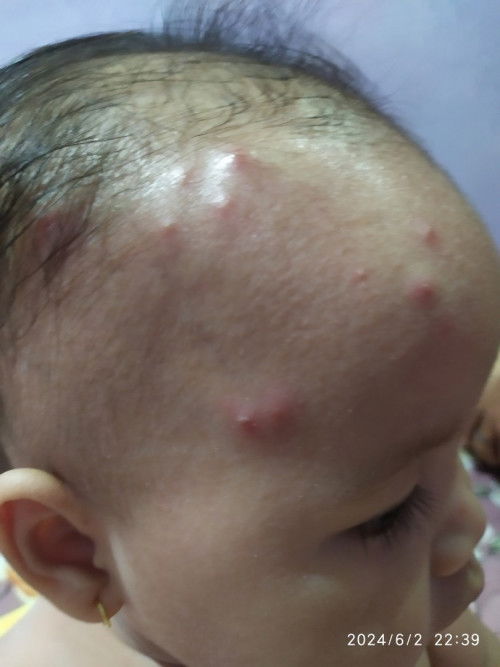 Timbul Bintil Merah Benanah