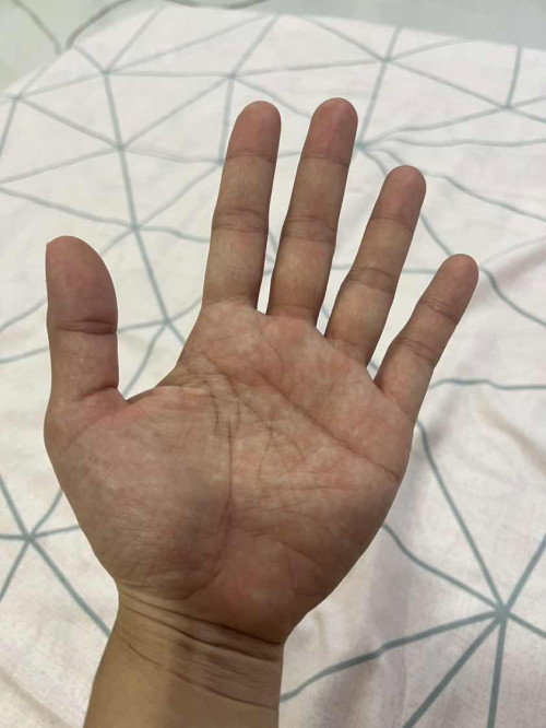 34weeks ปวดมือ แม่บ้านไหนเป็นเหมือนกันบ้างคะ พึ่งท้องแรกค่ะ