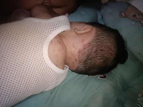 paano po malulunasan ang pigsa sa ulo ni.baby 9months old po sya may iniinom na antibiotic