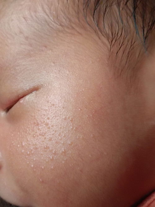 Bintik kecil pada muka bayi nb