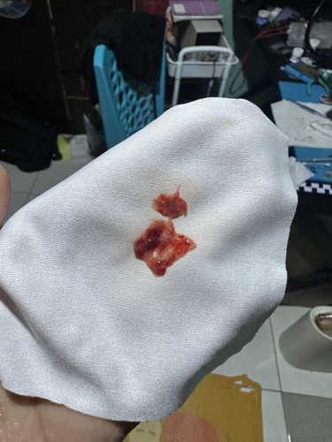 period berketul macam lemak daging
