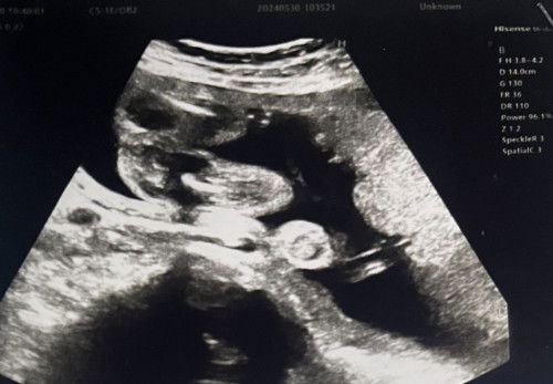 ลักษณะอาการแม่บ่งบอกเพศเป๊ะมั้ย?