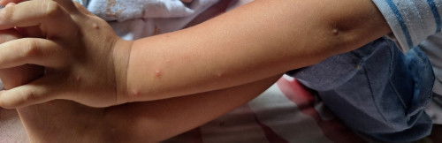 Ini cacar apa alergi ya