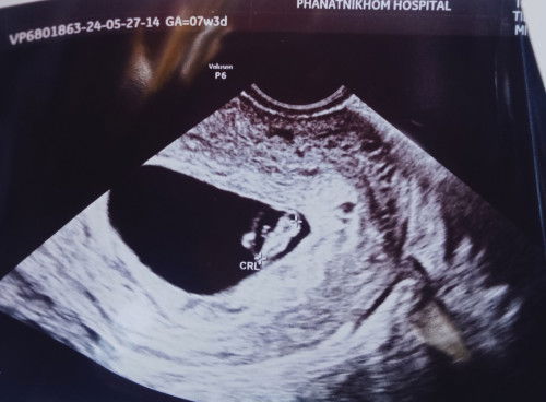 ตอนนี้น้อง7สัปดาตัวเล็กใหมคะพอดีดูไม่ค่อยเป็น ขอบคุณล่วงหน้าที่บอกนะคะ