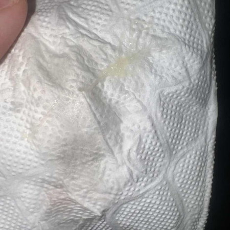 White discharge parang sipon