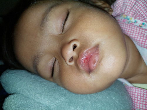 Bibir anak berdarah ada sedikit nanah