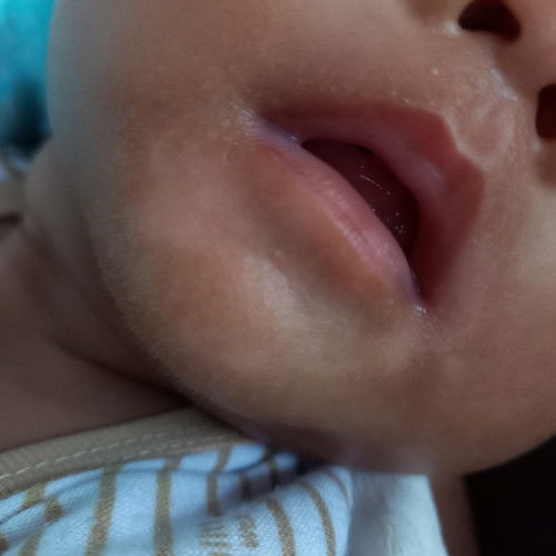 putih seperri panu pada daerah dagu bayi