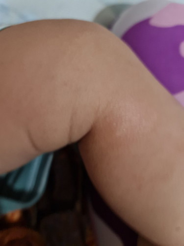 Lutut ada tompok putih tu kenapa ya..