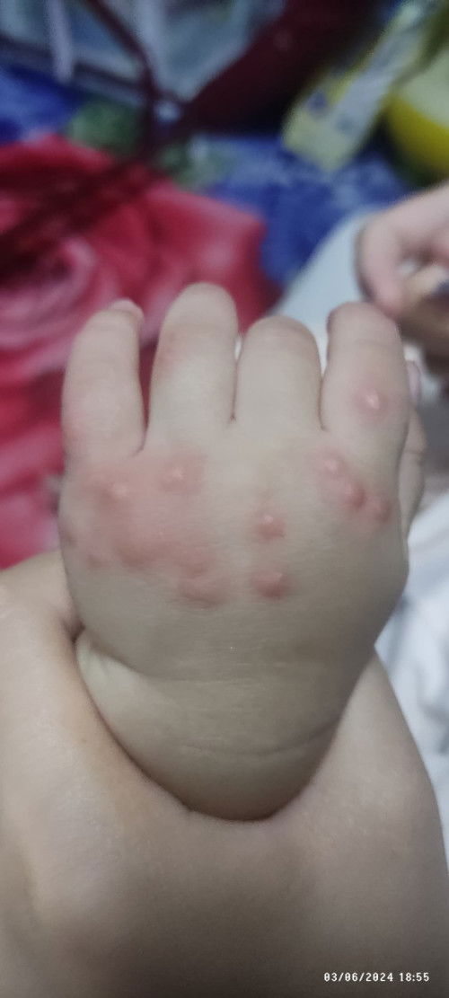 Tangan baby kemerahan dan bertukar jadi bintik2