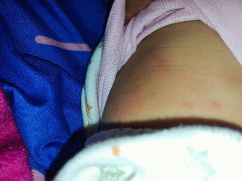 Herpes apa flu singapure ya bun?