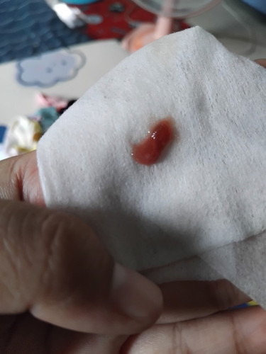 38วีค4 วัน มีมูกเเบบนี้ควรไปหาหมอเลยมั้ยคะ เเต่ยังไม่มีอาการปวดท้อง