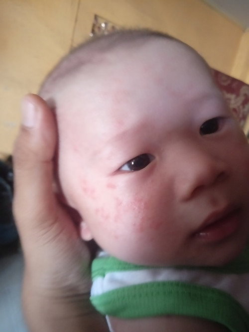 ruam pada bayi