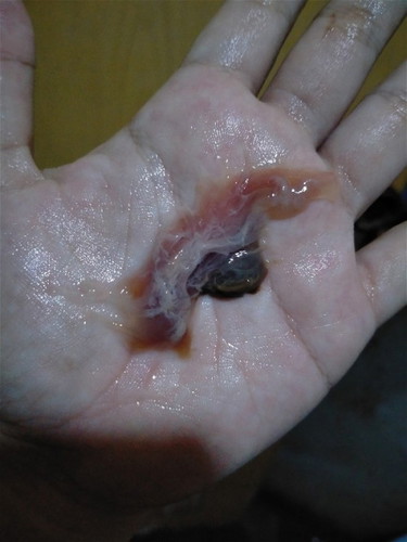 FTM, Mucus Plug