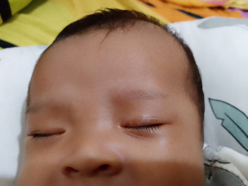 Jendilian di bagian atas mata